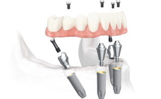 Зубная имплантация – что важно знать